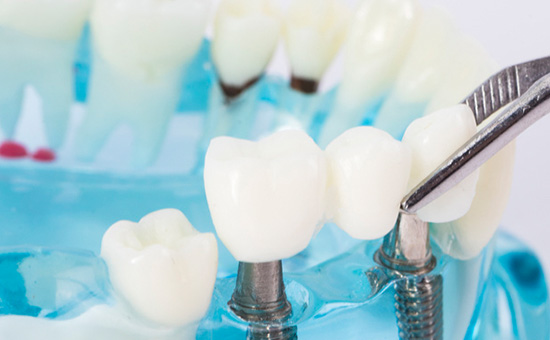 合肥种植牙医院专家科普种植牙_种植牙饮食注意事项(图1)