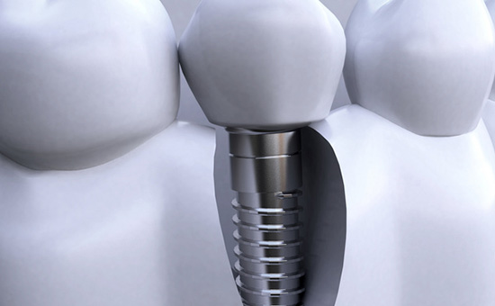 合肥种植牙医院精选“具体名单推荐一览”大牙也能做种植牙吗(图1)